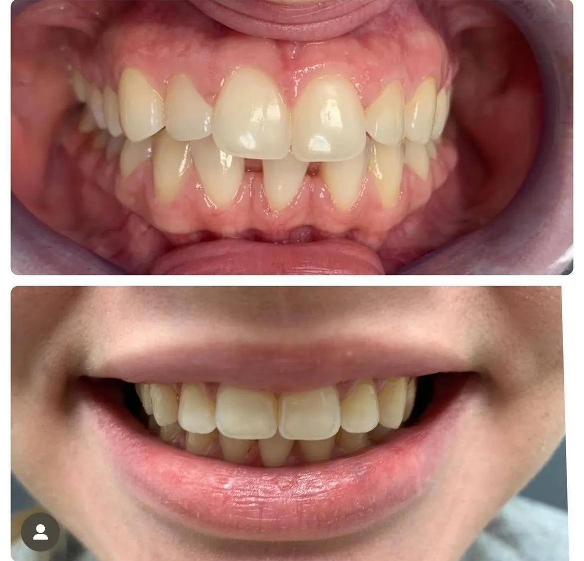 Invisalign before/after — patient 1