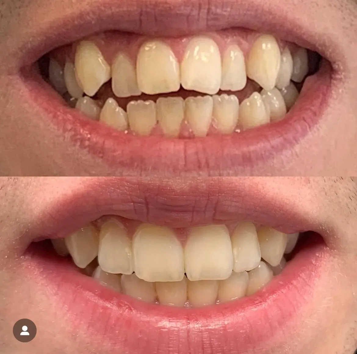 Invisalign before/after — patient 2