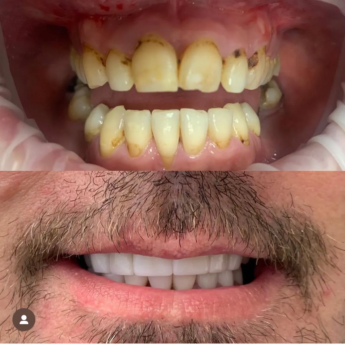 Invisalign before/after — patient 3