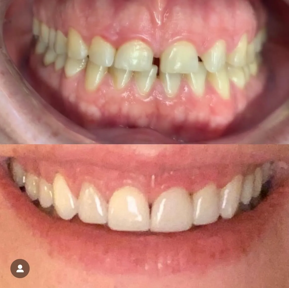 Invisalign before/after — patient 4