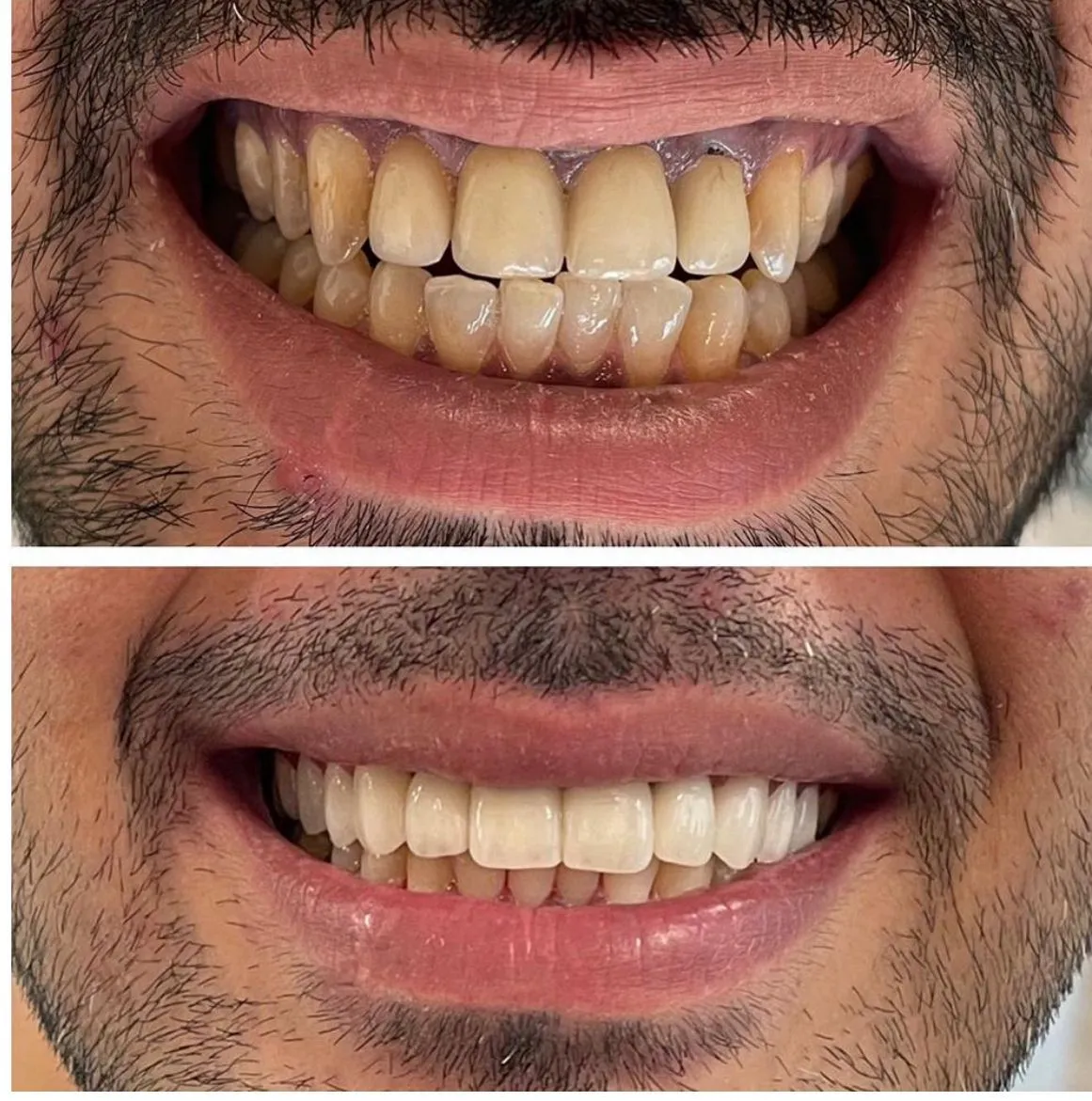 Invisalign before/after — patient 5