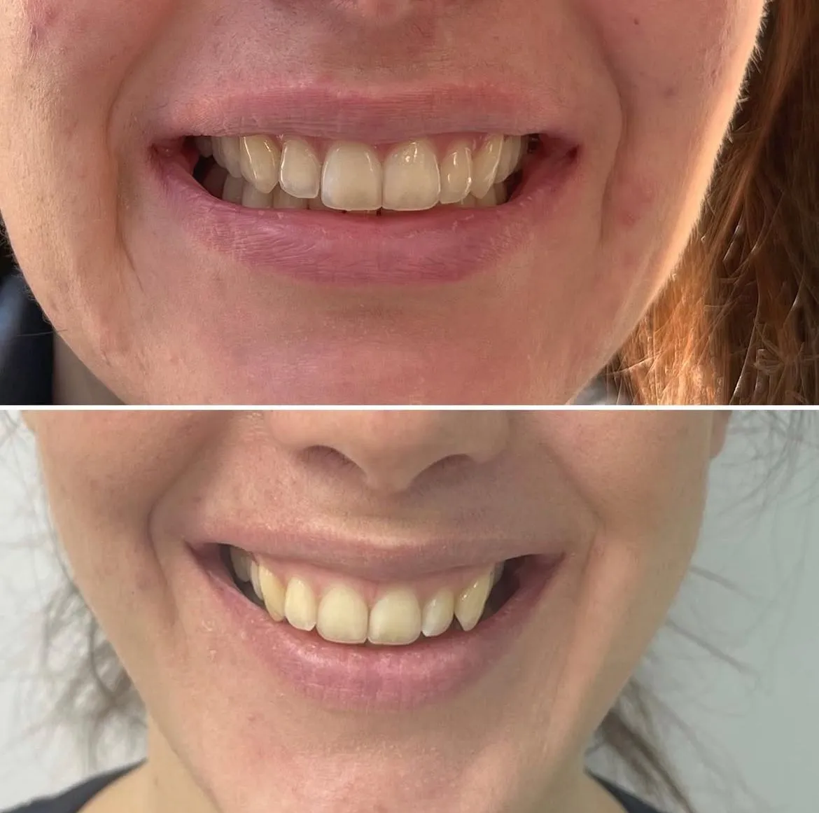 Invisalign before/after — patient 6