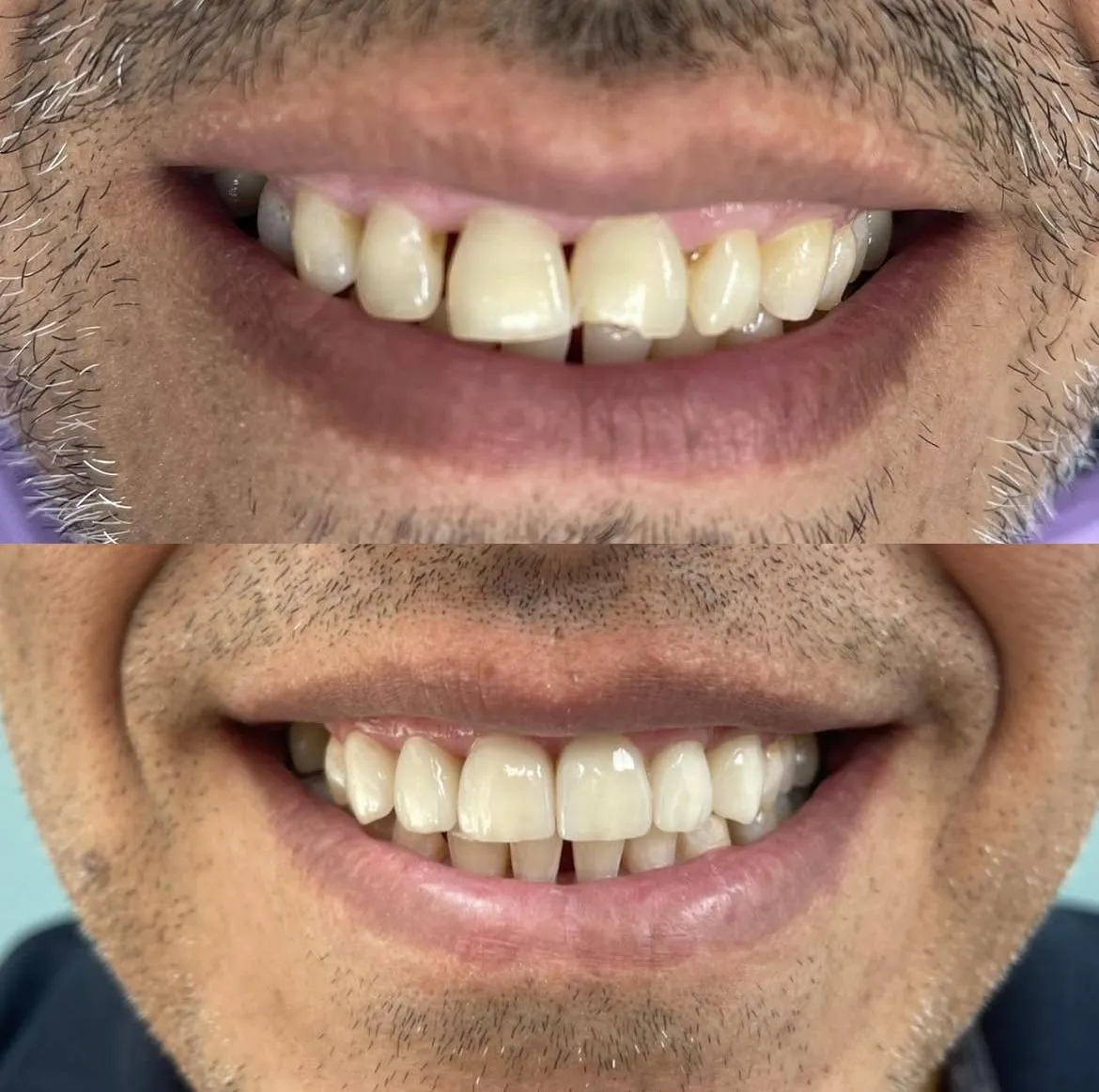 Invisalign before/after — patient 7
