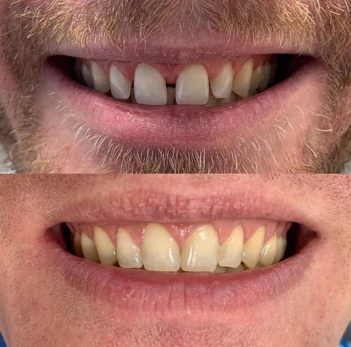 Invisalign before/after — patient 8